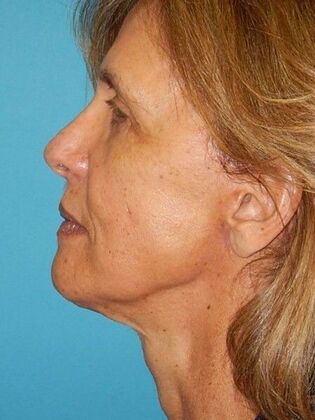 After Image: Face & Neck Lifts: Case 4 - left-side