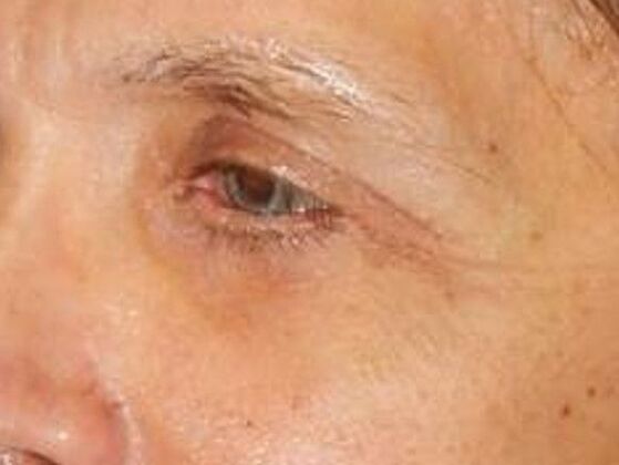 After Image: Face & Neck Lifts: Case 4 - left-front-oblique