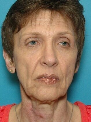 Before Image: Face & Neck Lifts: Case 4