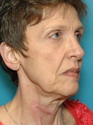 Before Image: Face & Neck Lifts: Case 4 - right-front-oblique