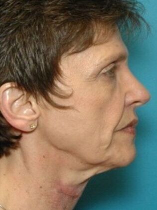 Before Image: Face & Neck Lifts: Case 4 - right-side