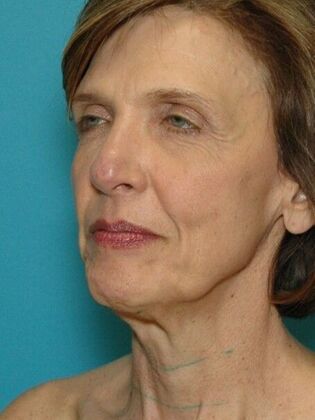 Before Image: Face & Neck Lifts: Case 4 - left-front-oblique