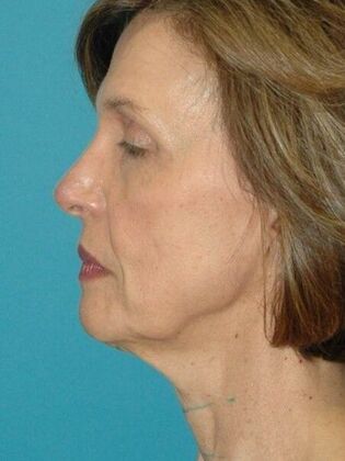 Before Image: Face & Neck Lifts: Case 4 - left-side