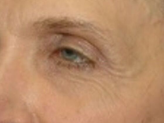 Before Image: Face & Neck Lifts: Case 4 - left-front-oblique