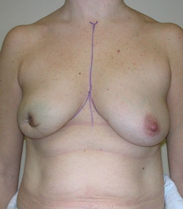 Before Image: Breast Reconstruction: Case 4 - front