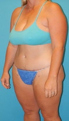 After Image: Brazilian Butt Lift: Case 4 - left-front-oblique