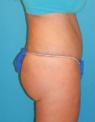 After Image: Brazilian Butt Lift: Case 4 - right-side