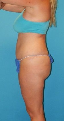 After Image: Brazilian Butt Lift: Case 4 - left-side