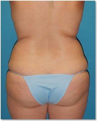 Before Image: Brazilian Butt Lift: Case 4 - back