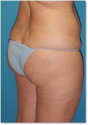 Before Image: Brazilian Butt Lift: Case 4 - right-back-oblique