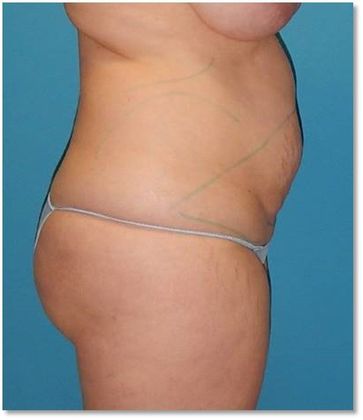 Before Image: Brazilian Butt Lift: Case 4 - right-side