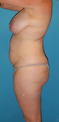 Before Image: Brazilian Butt Lift: Case 4 - left-side