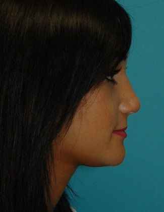 After Image: Soft Tissue Fillers: Case 4 - right-side