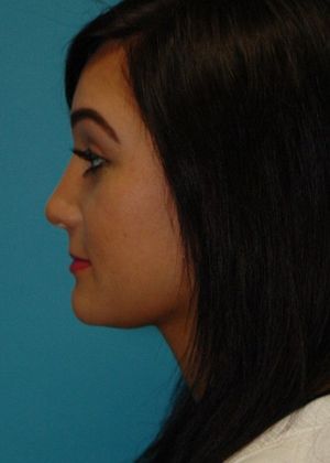 After Image: Soft Tissue Fillers: Case 4 - left-side