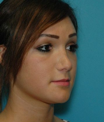 Before Image: Soft Tissue Fillers: Case 4 - right-front-oblique