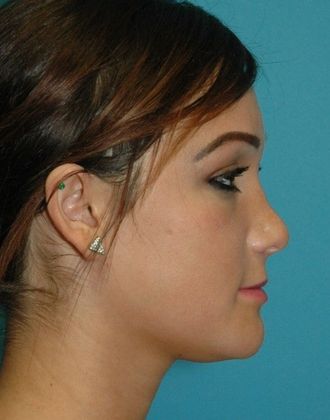 Before Image: Soft Tissue Fillers: Case 4 - right-side