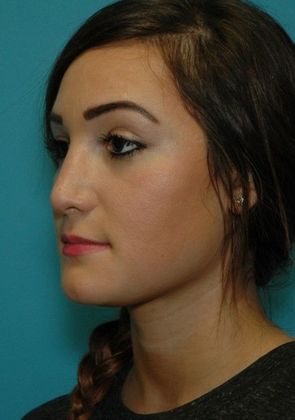 Before Image: Soft Tissue Fillers: Case 4 - left-front-oblique