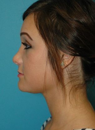 Before Image: Soft Tissue Fillers: Case 4 - left-side