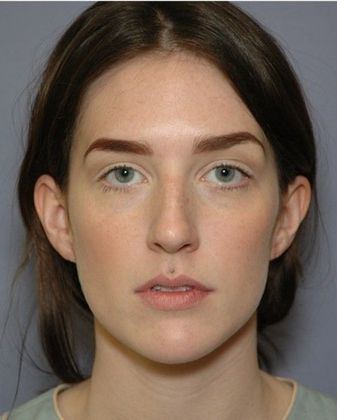 After Image: Otoplasty: Case 4 - front