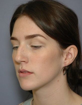 After Image: Otoplasty: Case 4 - left-front-oblique