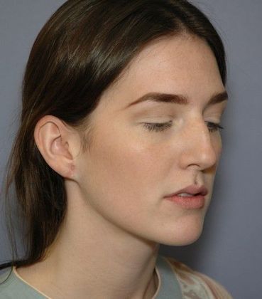 After Image: Otoplasty: Case 4 - right-front-oblique