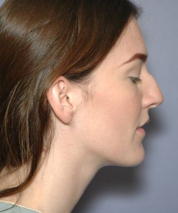 After Image: Otoplasty: Case 4 - right-side