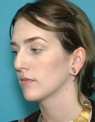 Before Image: Otoplasty: Case 4 - left-front-oblique