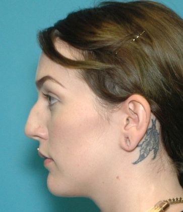 Before Image: Otoplasty: Case 4 - left-side