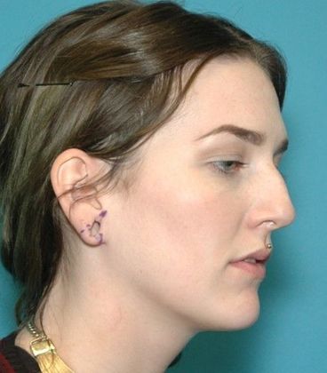 Before Image: Otoplasty: Case 4 - right-front-oblique