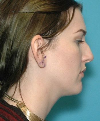 Before Image: Otoplasty: Case 4 - right-side