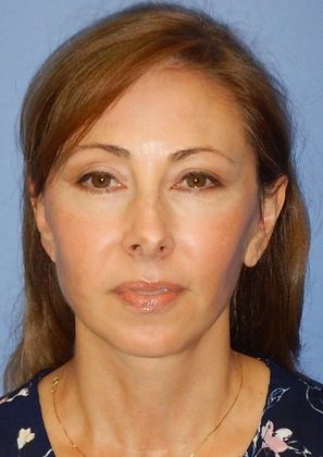After Image: Fat Grafting Face: Case 4 - front