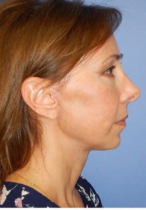 After Image: Fat Grafting Face: Case 4 - right-side