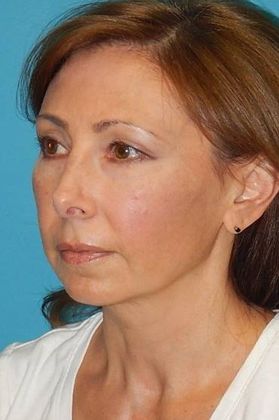 Before Image: Fat Grafting Face: Case 4 - left-front-oblique