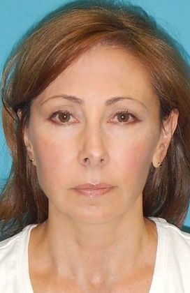 Before Image: Fat Grafting Face: Case 4 - front