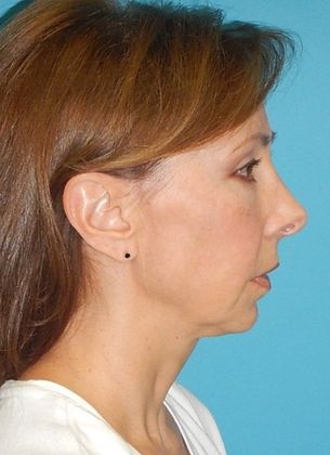 Before Image: Fat Grafting Face: Case 4 - right-side