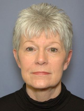 After Image: Neck Lift: Case 4 - front