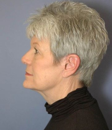 After Image: Neck Lift: Case 4 - left-side
