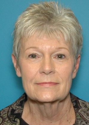 Before Image: Neck Lift: Case 4 - front