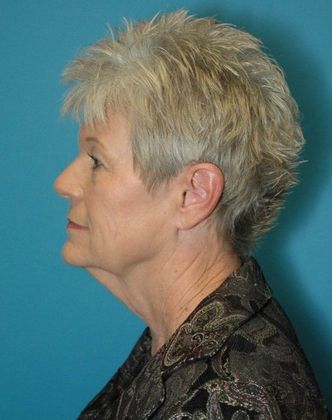 Before Image: Neck Lift: Case 4 - left-side