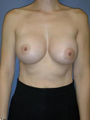 After Image: Breast Augmentation: Case5 - front