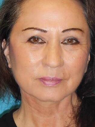After Image: Face & Neck Lifts: Case-5 - front