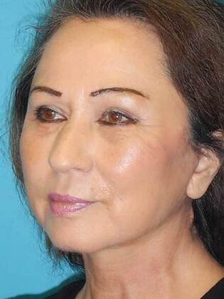 After Image: Face & Neck Lifts: Case-5 - left-front-oblique