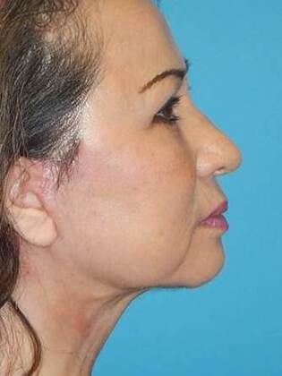 After Image: Face & Neck Lifts: Case-5 - right-side