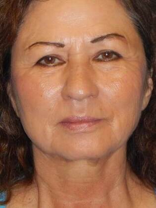 Before Image: Face & Neck Lifts: Case-5 - front