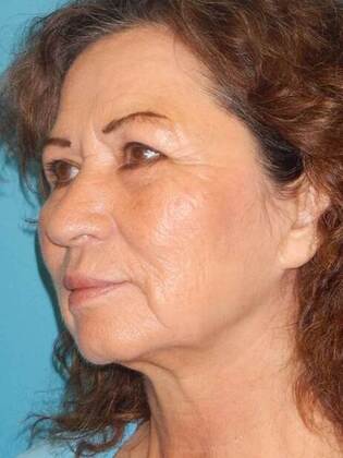 Before Image: Face & Neck Lifts: Case-5 - left-front-oblique