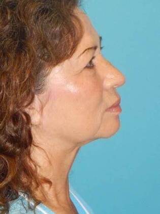 Before Image: Face & Neck Lifts: Case-5 - right-side