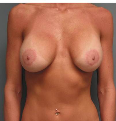 After Image: Breast Lift Augmentation: Case 5 - front