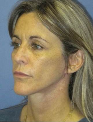 After Image: Mini Facelift: Case 5 - left-front-oblique