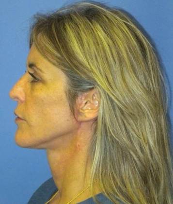 After Image: Mini Facelift: Case 5 - left-side