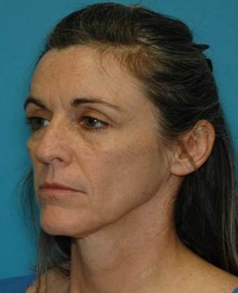 Before Image: Mini Facelift: Case 5 - left-front-oblique